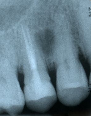 Lateral Periodontal cyst